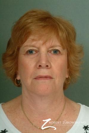 Facelift: Patient 10 - After Image 1