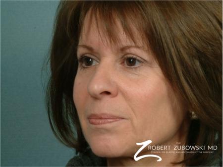 Blepharoplasty: Patient 11 - After Image 1