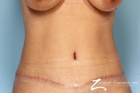 Tummy Tuck: Patient 20 - After Image 1