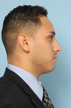 Rhinoplasty: Patient 3 - After Image 2