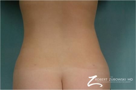 Liposuction: Patient 35 - After Image 1