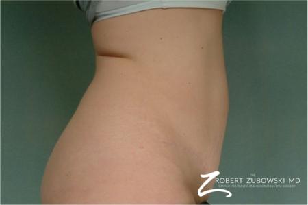 Tummy Tuck: Patient 22 - After Image 2