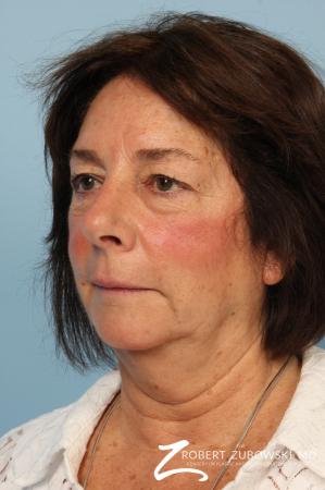 Blepharoplasty: Patient 37 - After Image 1