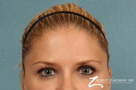 BOTOX® Cosmetic: Patient 3 - After Image 1