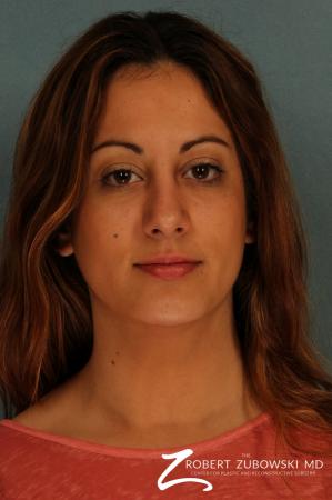 Rhinoplasty: Patient 16 - After Image 1