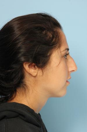 Rhinoplasty: Patient 20 - Before and After Image 3