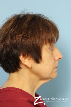 Blepharoplasty: Patient 14 - Before Image 2