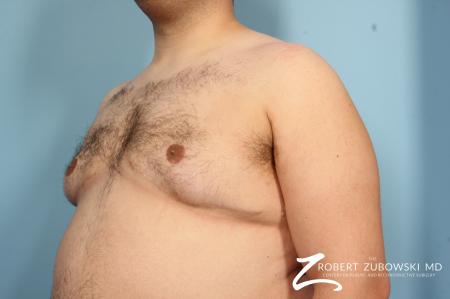 Gynecomastia: Patient 6 - After Image 2