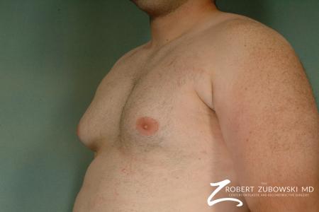 Gynecomastia: Patient 7 - Before and After Image 2