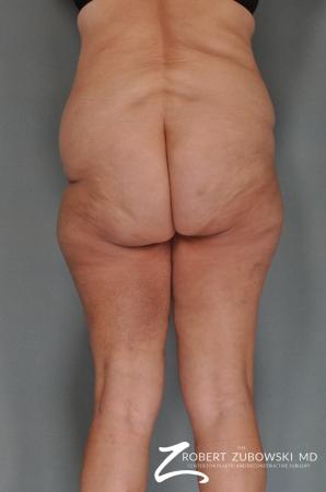 Body Lift: Patient 1 - Before and After Image 2