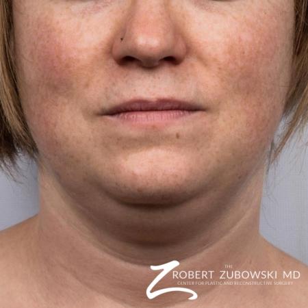 CoolSculpting®: Patient 1 - Before Image 1