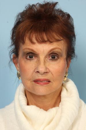 Blepharoplasty: Patient 12 - After Image 1