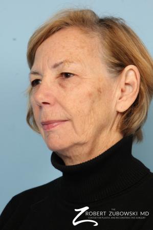 Blepharoplasty: Patient 32 - Before and After Image 2