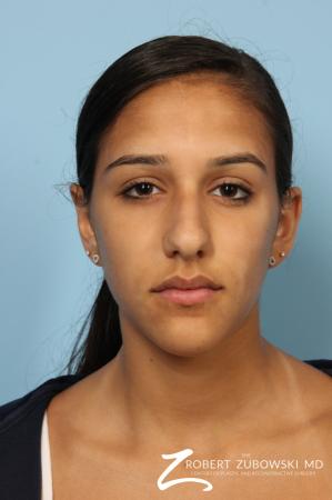 Rhinoplasty: Patient 14 - Before Image 1
