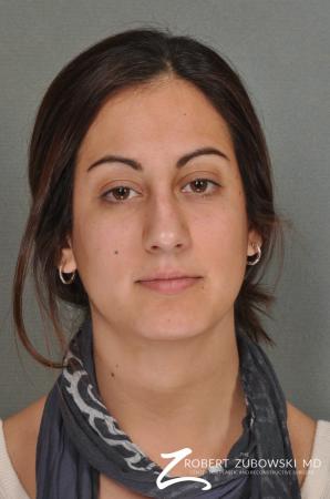 Rhinoplasty: Patient 16 - Before Image 1