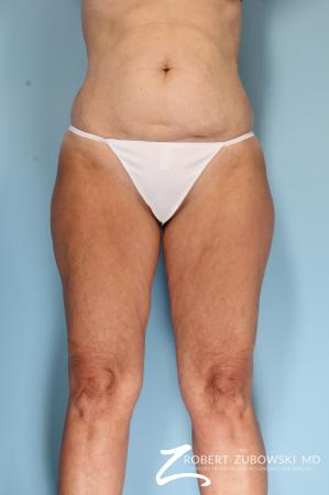 Liposuction: Patient 46 - Before Image 1