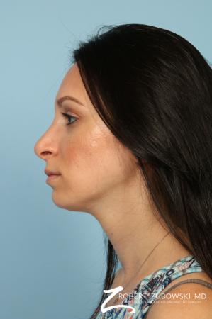 Rhinoplasty: Patient 25 - After Image 2