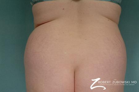 Liposuction: Patient 28 - Before Image 1