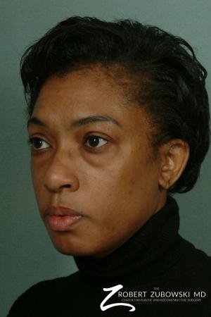 Blepharoplasty: Patient 3 - Before and After Image 2