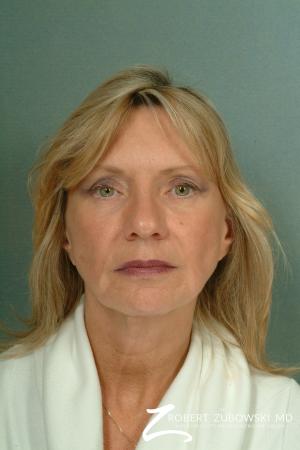 Facelift: Patient 13 - Before Image 1