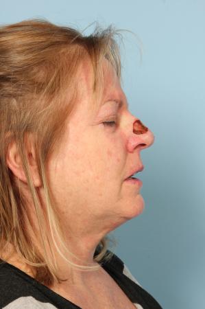 Mohs Closure: Patient 1 - Before and After Image 3