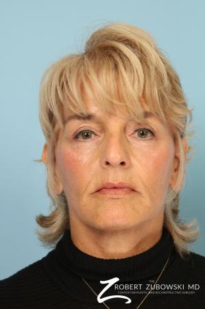 Facelift: Patient 27 - After Image 1