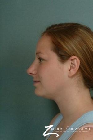 Rhinoplasty: Patient 5 - After Image 2