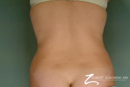 Liposuction: Patient 24 - After Image 2