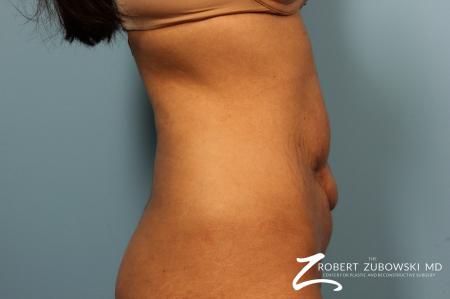 Tummy Tuck: Patient 8 - Before and After Image 2