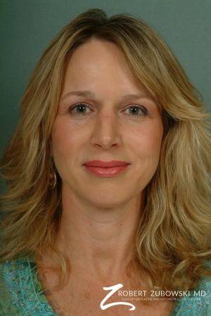 Chin Augmentation: Patient 3 - After Image 1