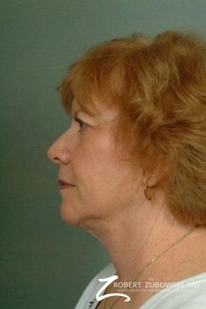Facelift: Patient 10 - After Image 2