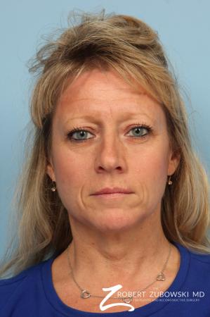 Blepharoplasty: Patient 28 - Before Image 1