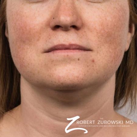 CoolSculpting®: Patient 1 - After Image 1