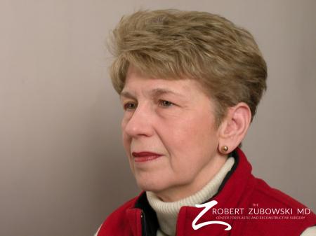 Blepharoplasty: Patient 20 - Before and After Image 2