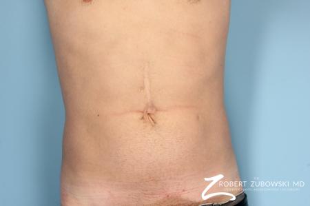 Liposuction: Patient 16 - Before Image 1