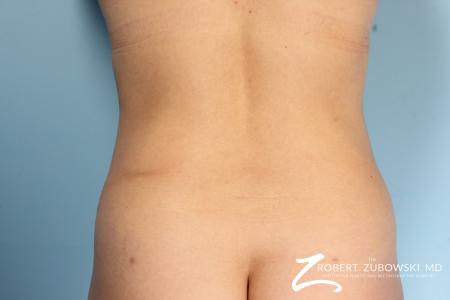 Liposuction: Patient 8 - After Image 1
