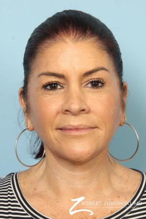Neck Lift: Patient 10 - After Image 1
