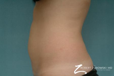 Liposuction: Patient 31 - Before and After Image 3