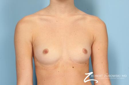 Breast Augmentation: Patient 8 - Before Image 1