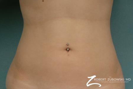 Liposuction: Patient 31 - After Image 1