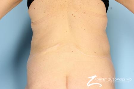 CoolSculpting®: Patient 2 - Before and After Image 5