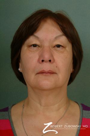 Blepharoplasty: Patient 23 - Before Image 1