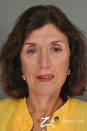 Facelift: Patient 6 - After Image 1