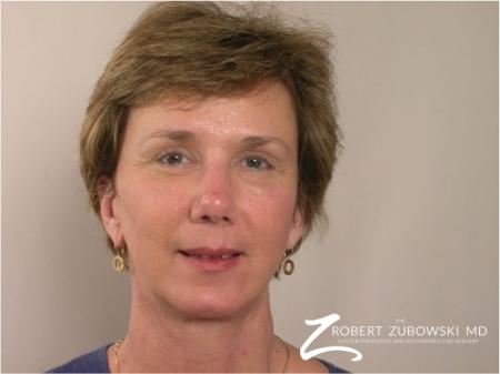 Brow Lift: Patient 2 - After Image 1