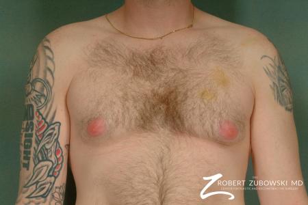 Gynecomastia: Patient 2 - Before Image 1