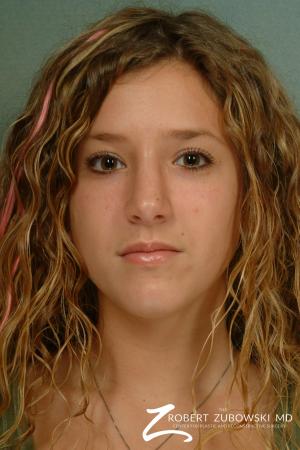 Rhinoplasty: Patient 12 - Before Image 1