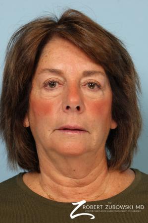 Blepharoplasty: Patient 37 - Before and After Image 2