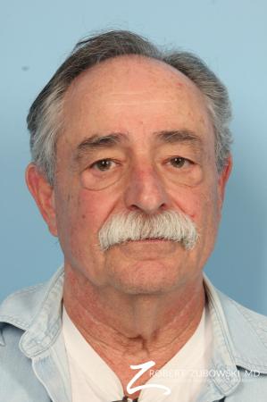 Neck Lift: Patient 6 - Before Image 1