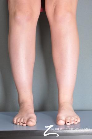 Liposuction: Patient 21 - Before Image 1