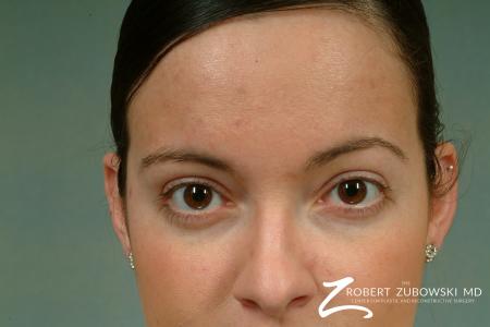 Latisse: Patient 1 - Before and After Image 2